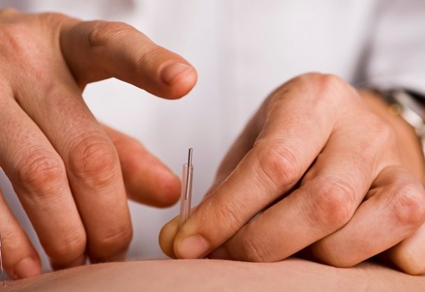 Acupuncture